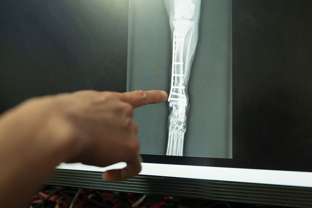 A close-up of a medical X-ray showing a lower leg with a metal plate and screws, while a person points to the fracture area on a screen.